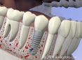 Dental Implant