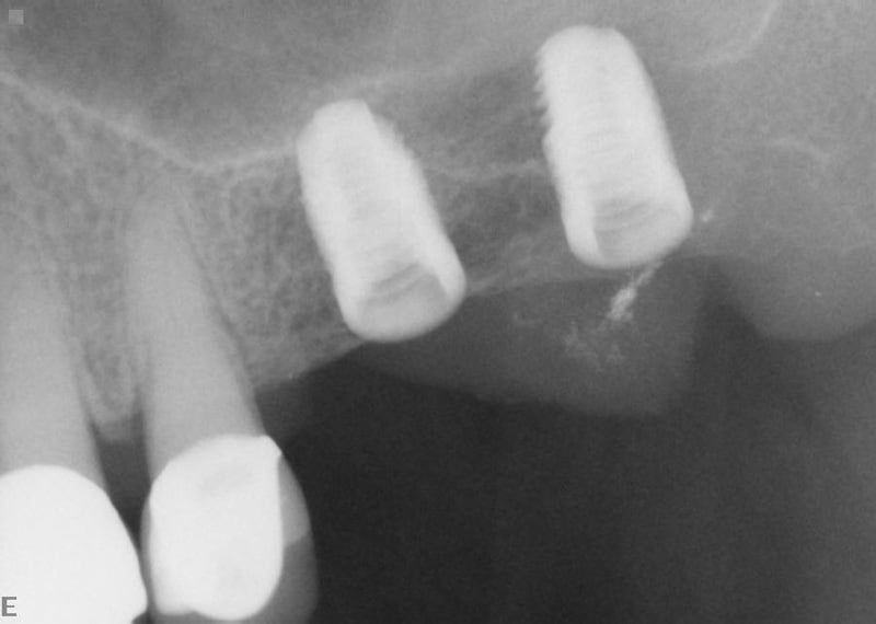 Immediate post-op x-ray of lateral window sinus lift procedure with 2 implants placement by Dr. Yeh in Pinole CA