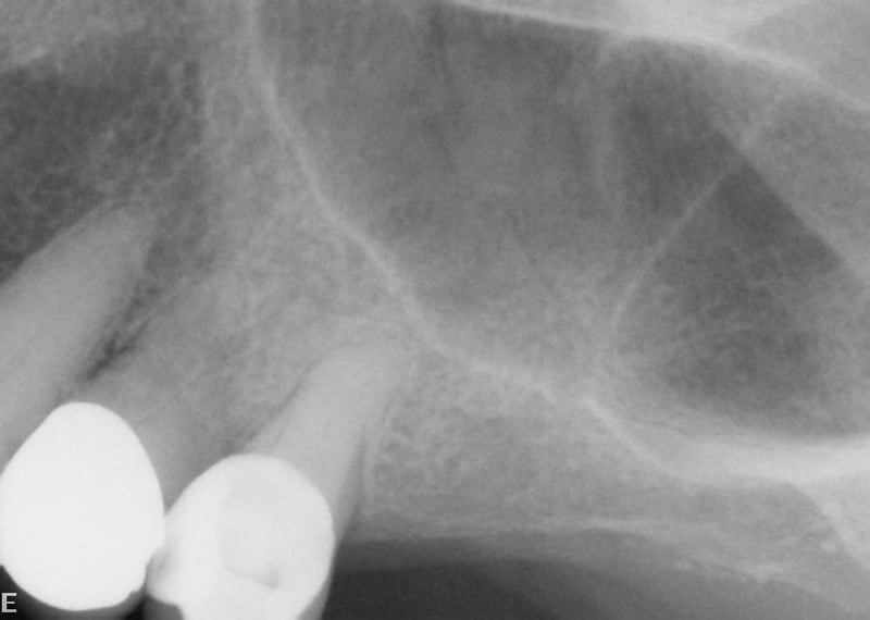 Pre x-ray of lateral window sinus lift procedure with 2 implants placement by Dr. Yeh in Pinole CA