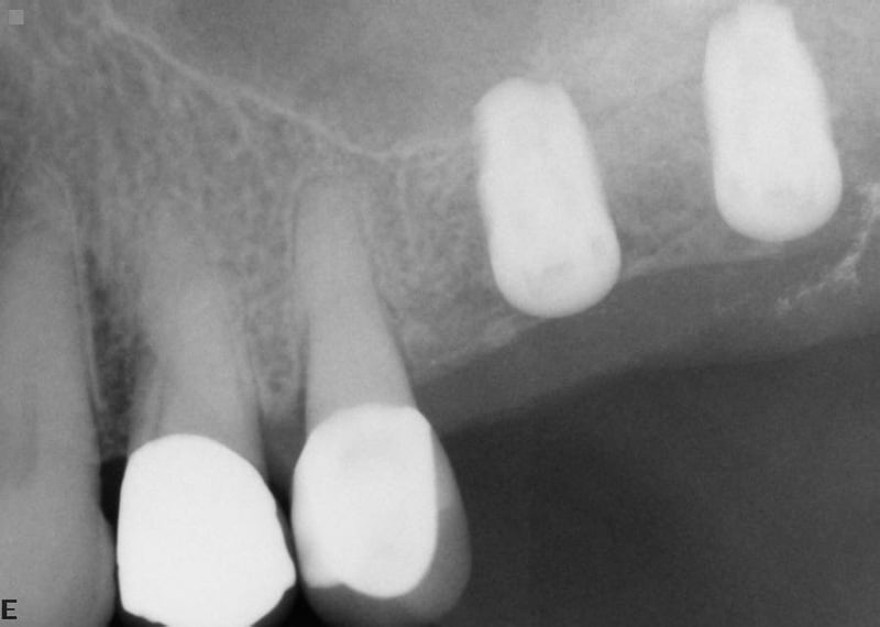 Recall X-ray of lateral window sinus lift procedure with 2 implants placement by Dr. Yeh in Pinole CA