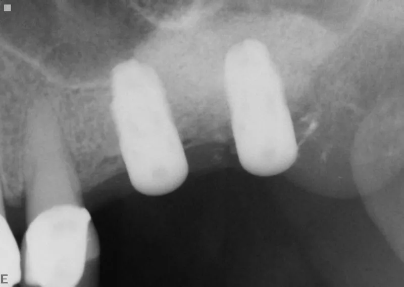 Recall 2 X-ray of lateral window sinus lift procedure with 2 implants placement by Dr. Yeh in Pinole CA