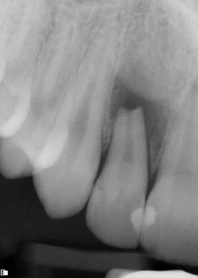 traumatized upper right lateral incisor