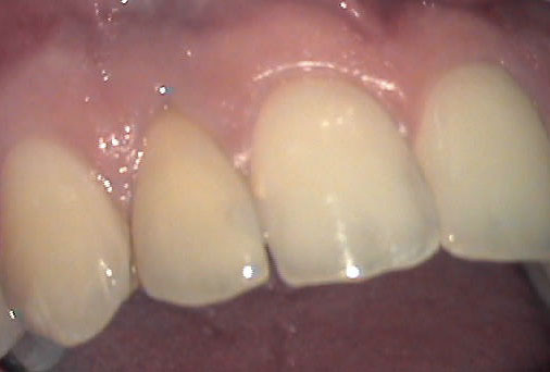 Intraoral photo: upper anterior teeth with mild discoloration, smooth enamel, healthy gingiva