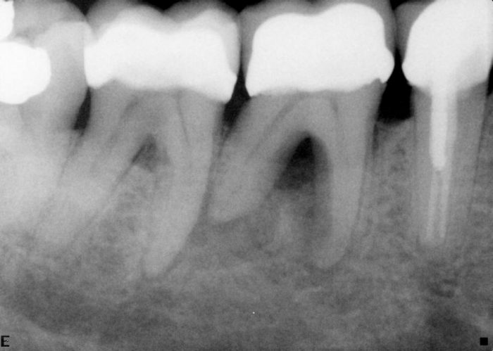 Extensive lesion, endodontic treatment
