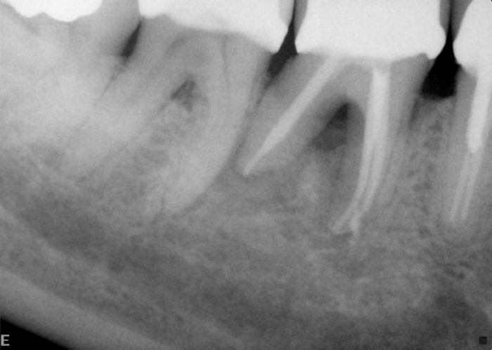 Lesion, endodontically treated
