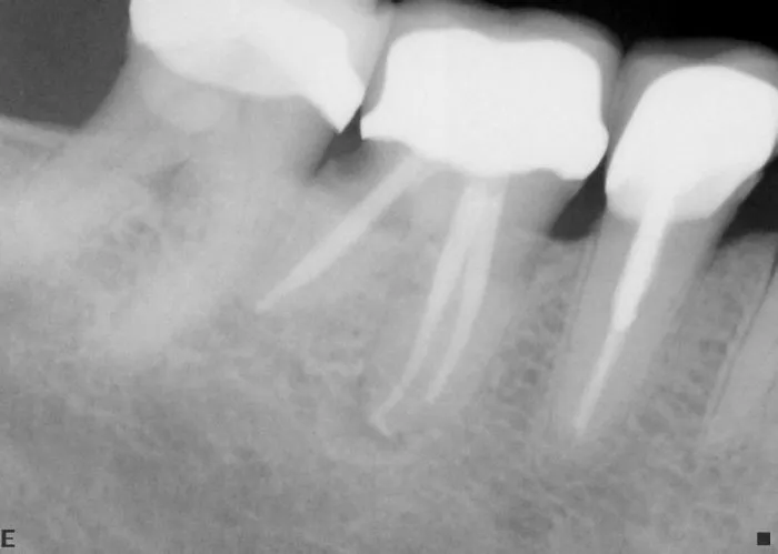 Endodontic treatment success
