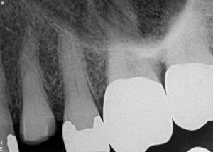 X-ray of Severely calcified canal system