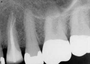 X-ray of Severely calcified canal system