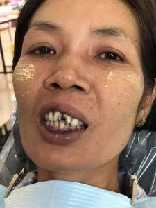 A patient with front decayed teeth